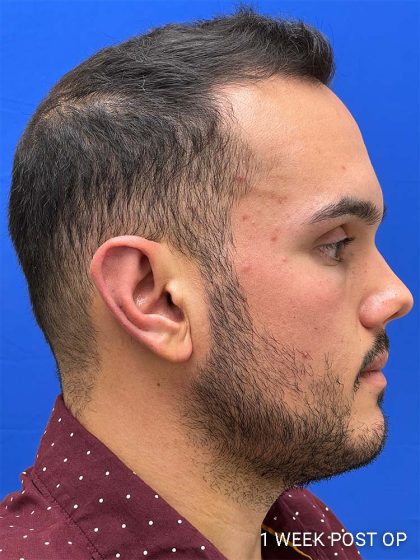Otoplasty Before & After Patient #993