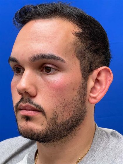 Otoplasty Before & After Patient #993