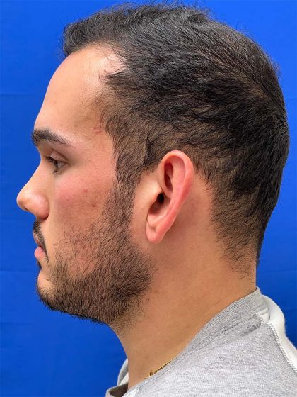 Otoplasty Before & After Patient #993