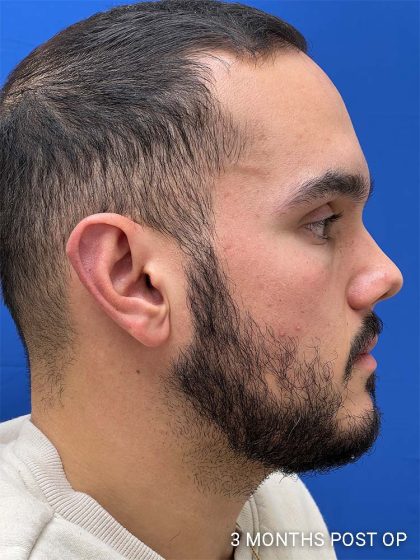 Otoplasty Before & After Patient #993