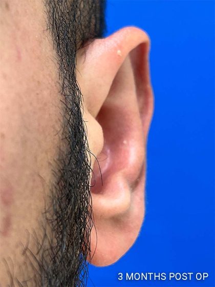 Otoplasty Before & After Patient #993