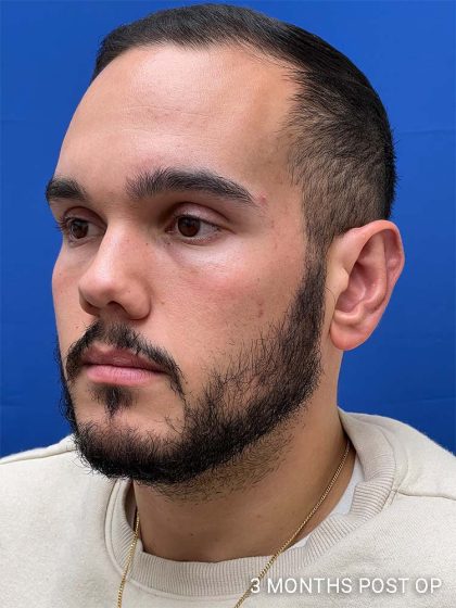 Otoplasty Before & After Patient #993