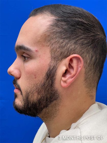 Otoplasty Before & After Patient #993