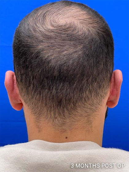 Otoplasty Before & After Patient #993