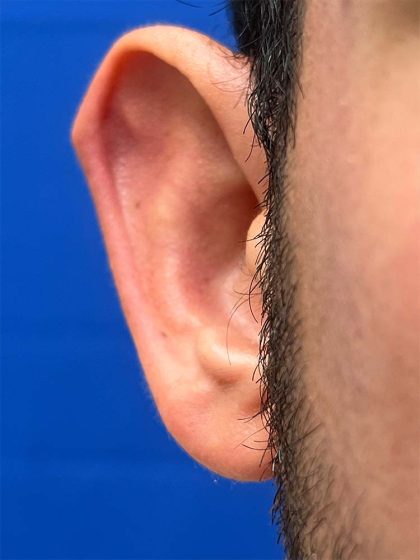 Otoplasty Before & After Patient #993