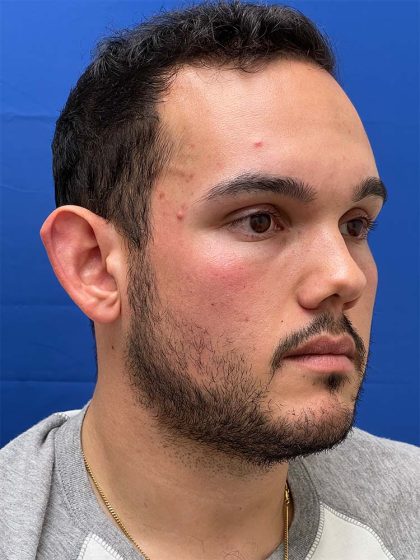 Otoplasty Before & After Patient #993