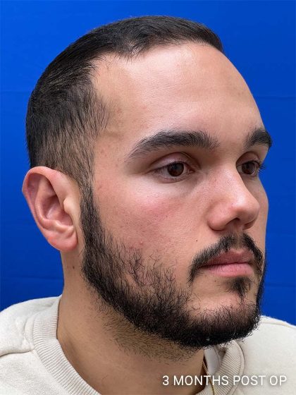 Otoplasty Before & After Patient #993