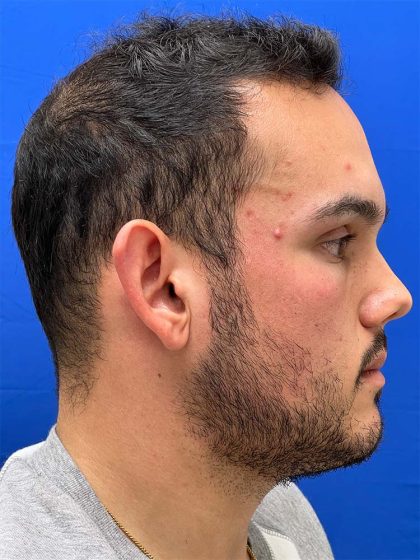 Otoplasty Before & After Patient #993