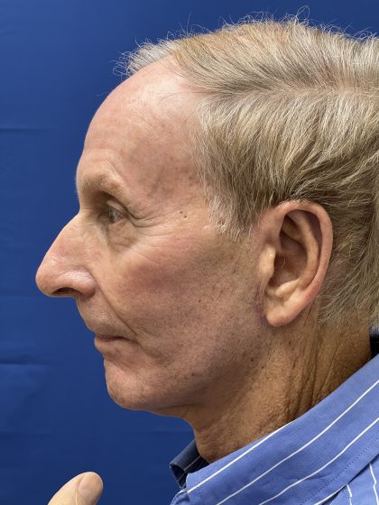 Otoplasty Before & After Patient #9411