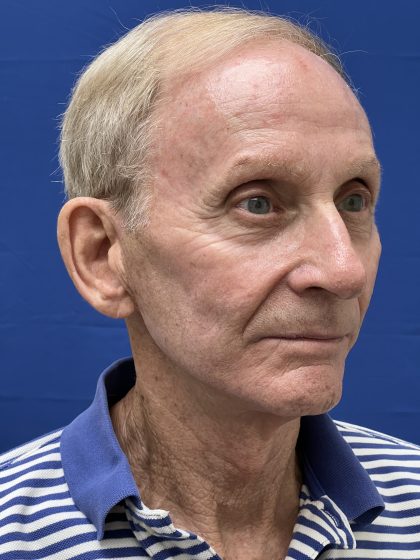 Otoplasty Before & After Patient #9411