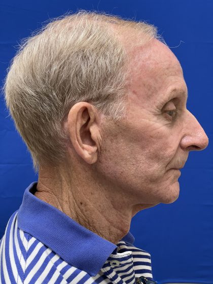Otoplasty Before & After Patient #9411