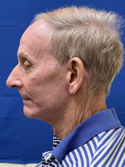 Otoplasty Before & After Patient #9411