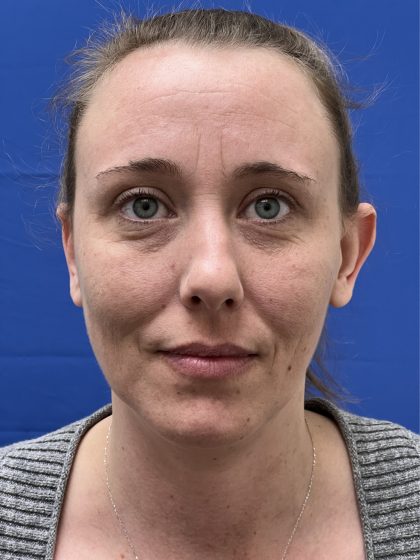 Otoplasty Before & After Patient #977