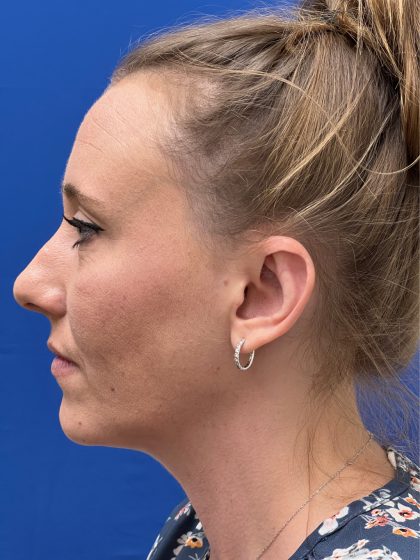 Otoplasty Before & After Patient #977