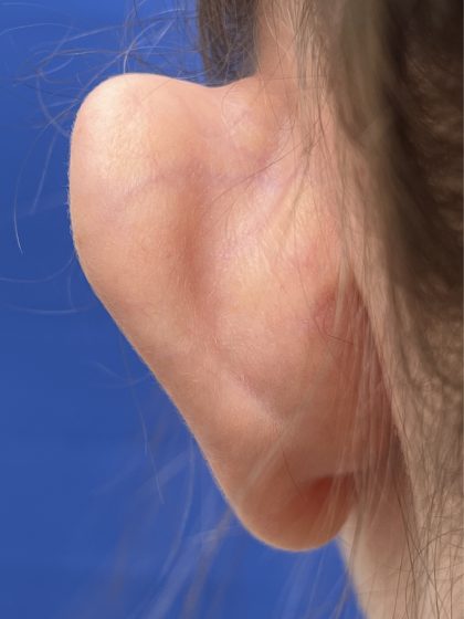Otoplasty Before & After Patient #977