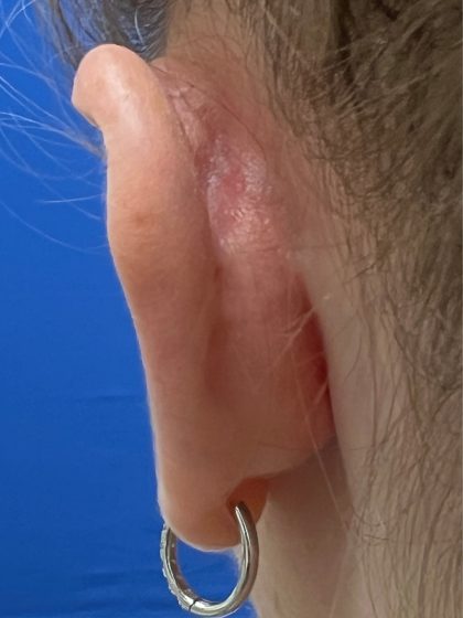 Otoplasty Before & After Patient #977