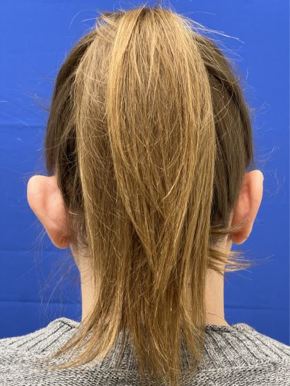 Otoplasty Before & After Patient #977