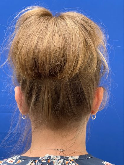 Otoplasty Before & After Patient #977