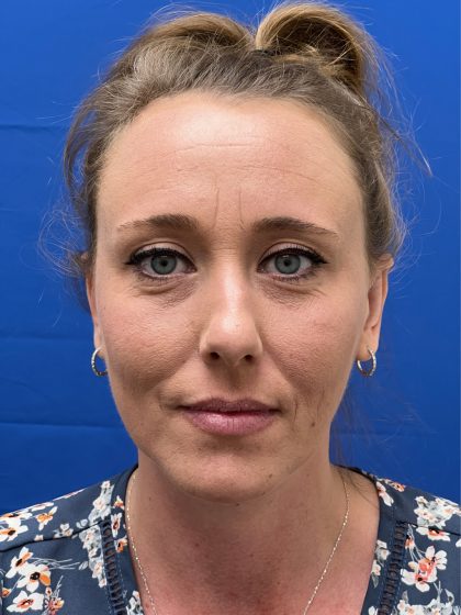 Otoplasty Before & After Patient #977