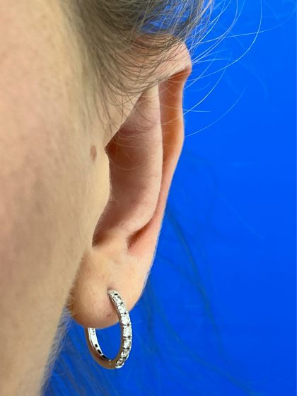 Otoplasty Before & After Patient #977