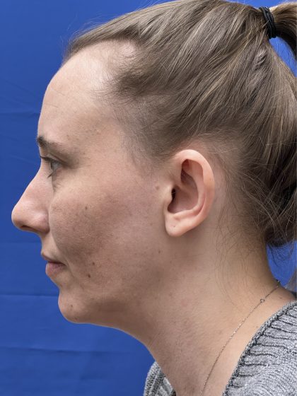 Otoplasty Before & After Patient #977
