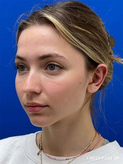 Otoplasty Before & After Patient #986
