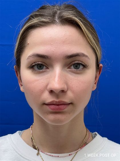 Otoplasty Before & After Patient #986