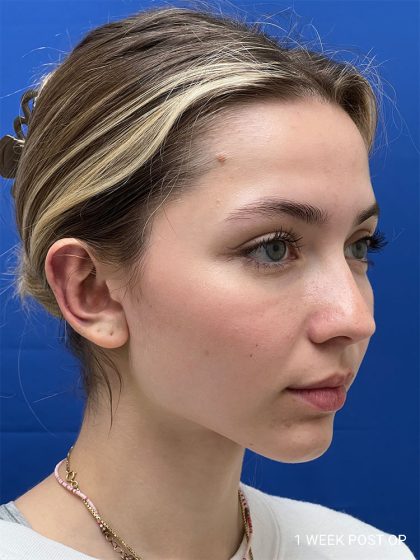 Otoplasty Before & After Patient #986