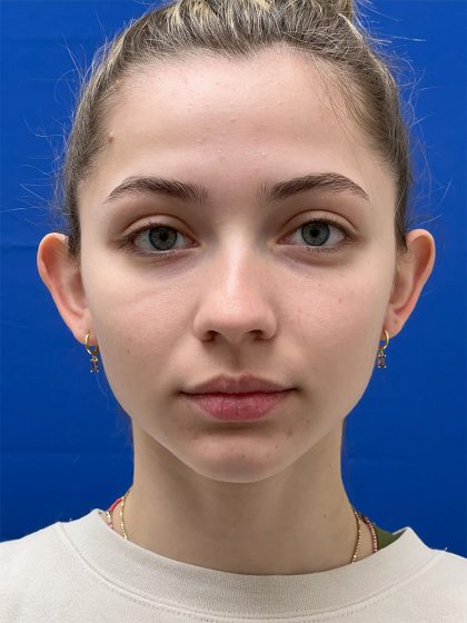 Otoplasty Before & After Patient #986