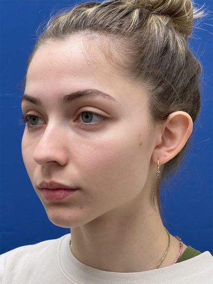 Otoplasty Before & After Patient #986