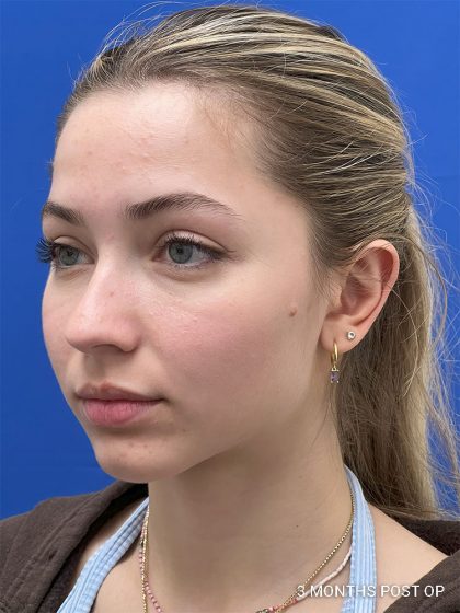 Otoplasty Before & After Patient #986