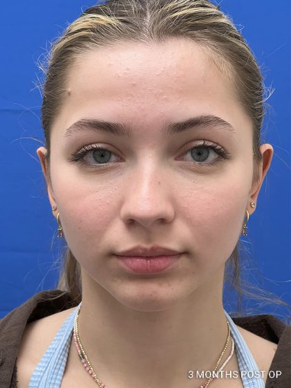 Otoplasty Before & After Patient #986
