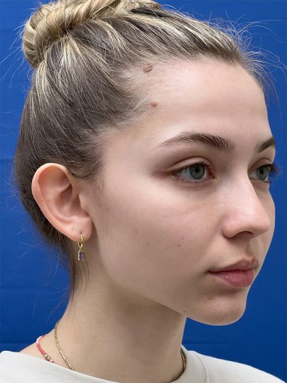 Otoplasty Before & After Patient #986