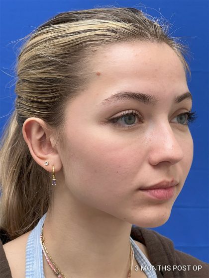 Otoplasty Before & After Patient #986