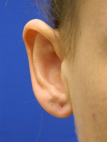Otoplasty Before & After Patient #1027