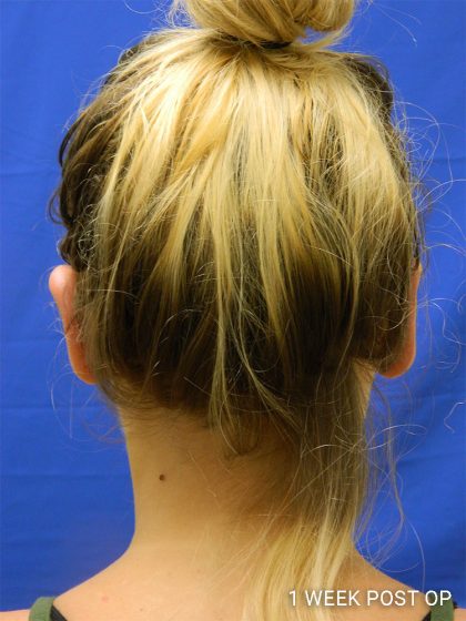 Otoplasty Before & After Patient #1027