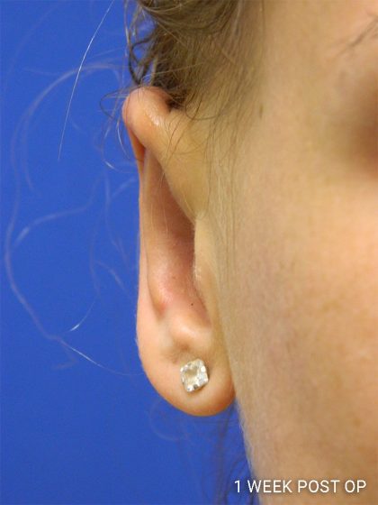 Otoplasty Before & After Patient #1027