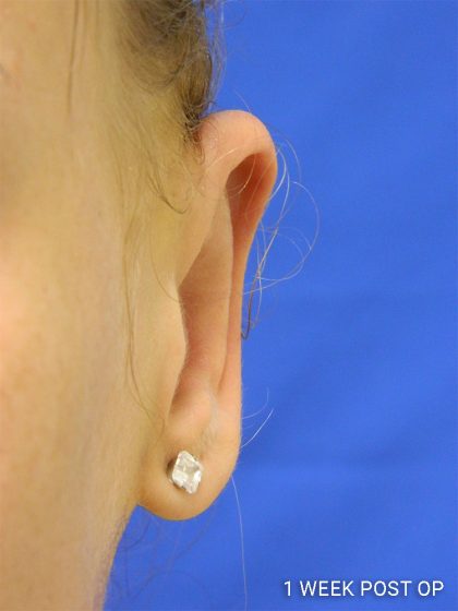 Otoplasty Before & After Patient #1027
