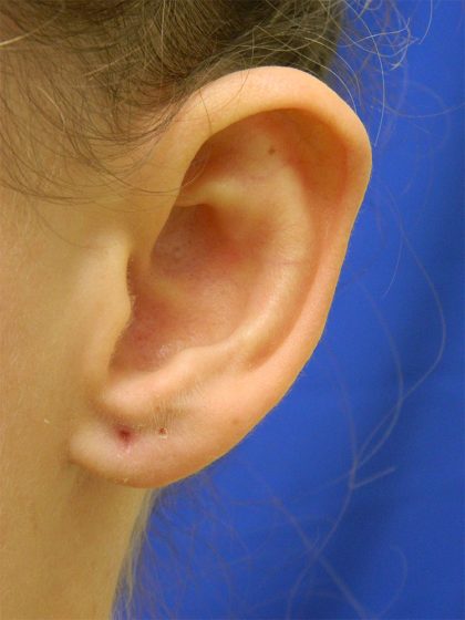 Otoplasty Before & After Patient #1027