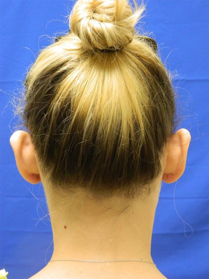 Otoplasty Before & After Patient #1027