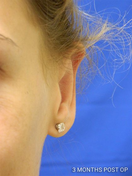 Otoplasty Before & After Patient #1027