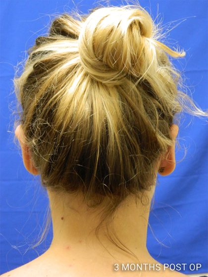 Otoplasty Before & After Patient #1027