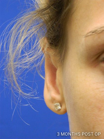 Otoplasty Before & After Patient #1027