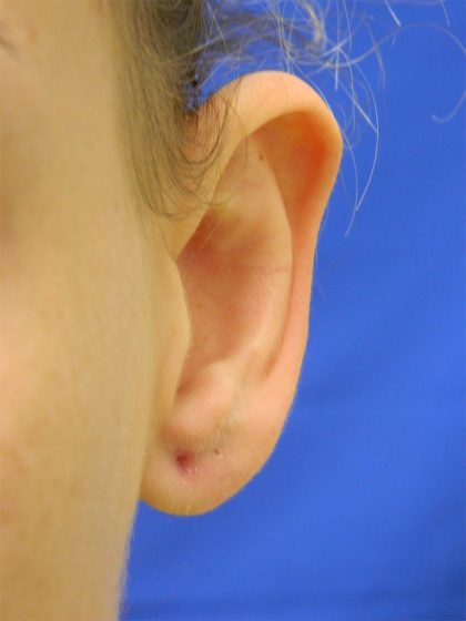 Otoplasty Before & After Patient #1027
