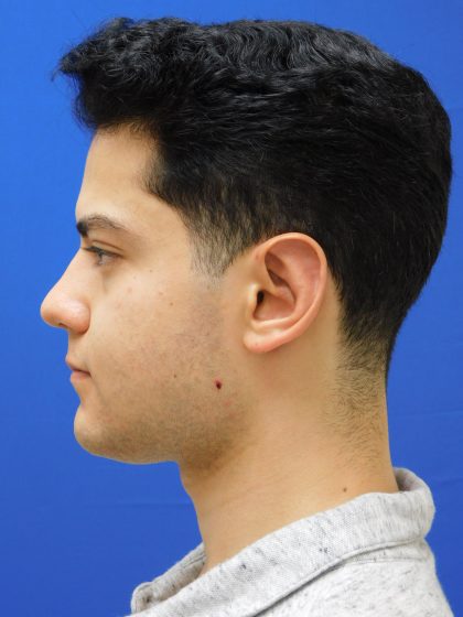 Otoplasty Before & After Patient #1020