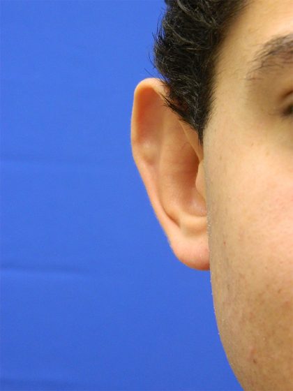 Otoplasty Before & After Patient #1020