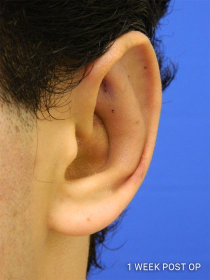 Otoplasty Before & After Patient #1020