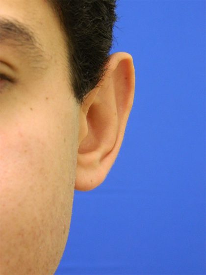 Otoplasty Before & After Patient #1020