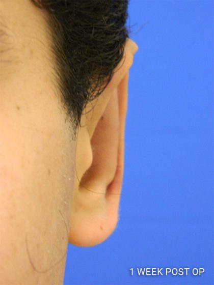 Otoplasty Before & After Patient #1020