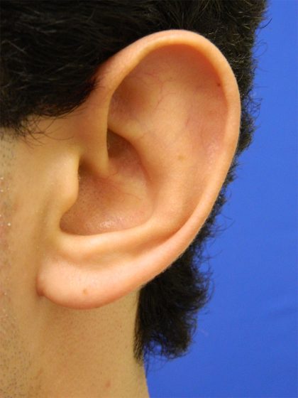 Otoplasty Before & After Patient #1020